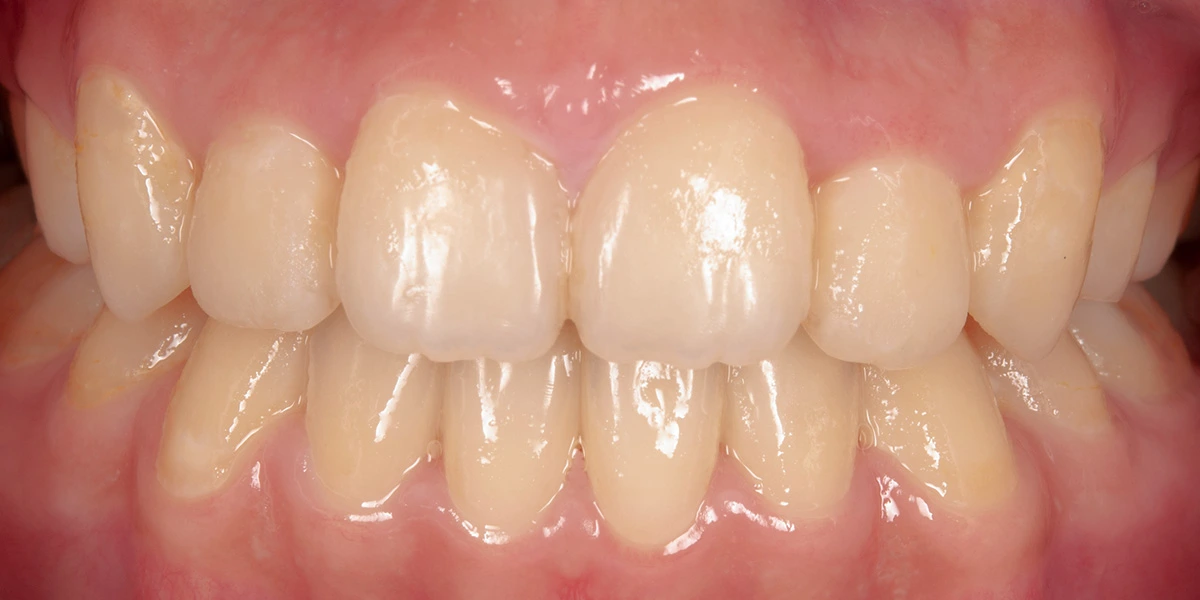 治療後写真 | 噛み合わせ治療・矯正歯科専門 荒谷デンタルクリニック