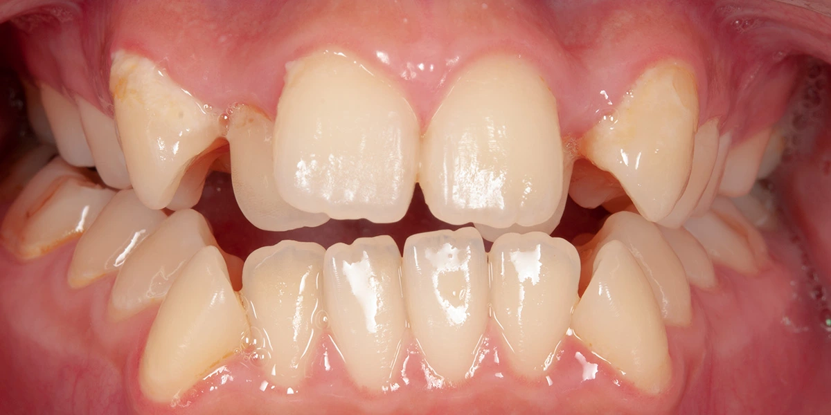 治療前写真 | 噛み合わせ治療・矯正歯科専門 荒谷デンタルクリニック