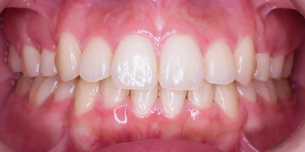 治療後写真 | 噛み合わせ治療・矯正歯科専門 荒谷デンタルクリニック