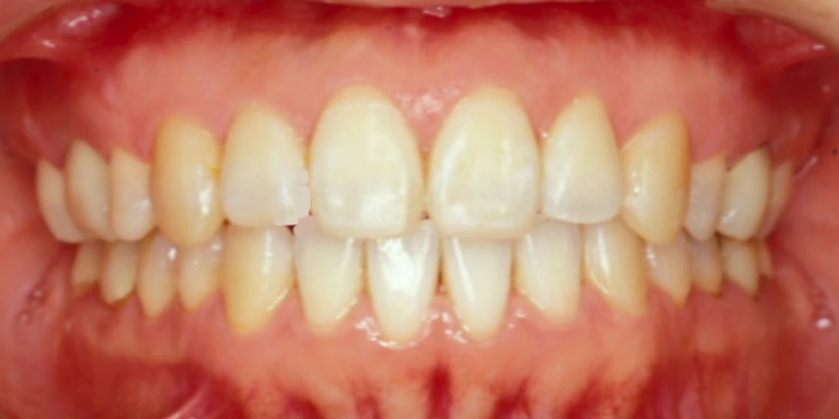 治療後写真 | 噛み合わせ治療・矯正歯科専門 荒谷デンタルクリニック