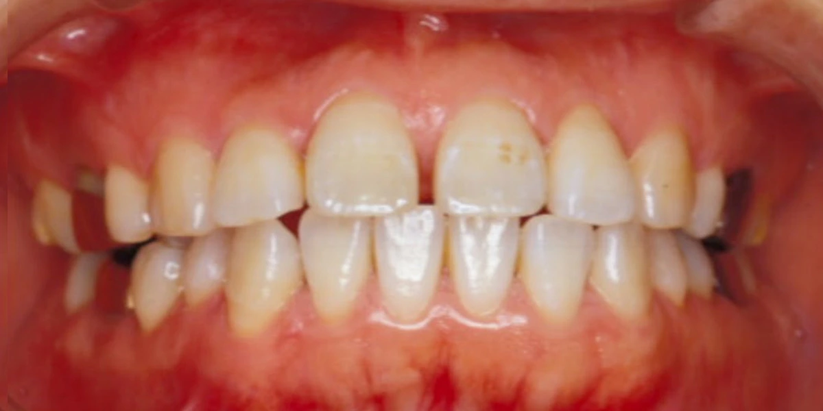 治療前写真 | 噛み合わせ治療・矯正歯科専門 荒谷デンタルクリニック