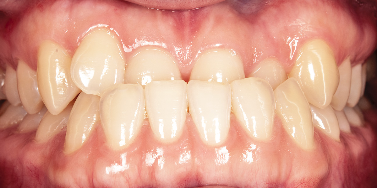 治療前写真 | 噛み合わせ治療・矯正歯科専門 荒谷デンタルクリニック