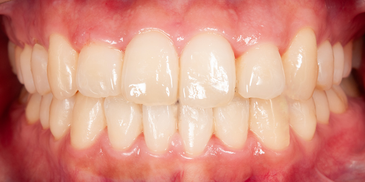 治療後写真 | 噛み合わせ治療・矯正歯科専門 荒谷デンタルクリニック