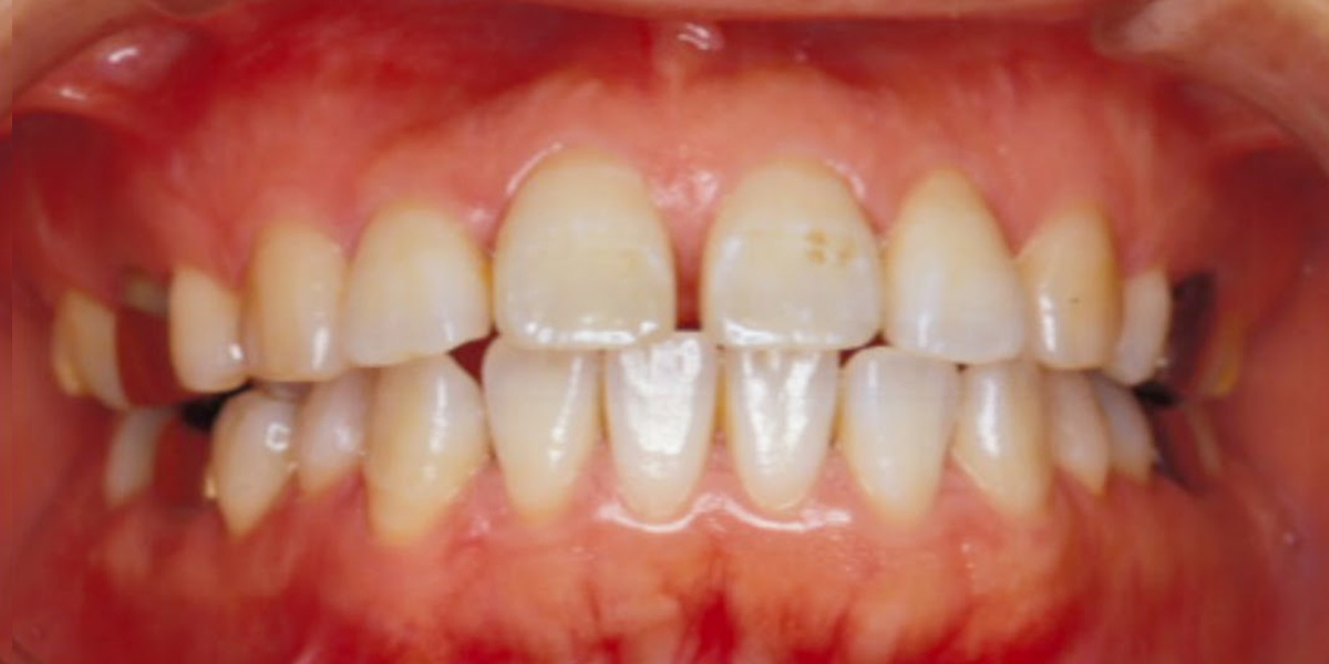 治療前写真 | 噛み合わせ治療・矯正歯科専門 荒谷デンタルクリニック
