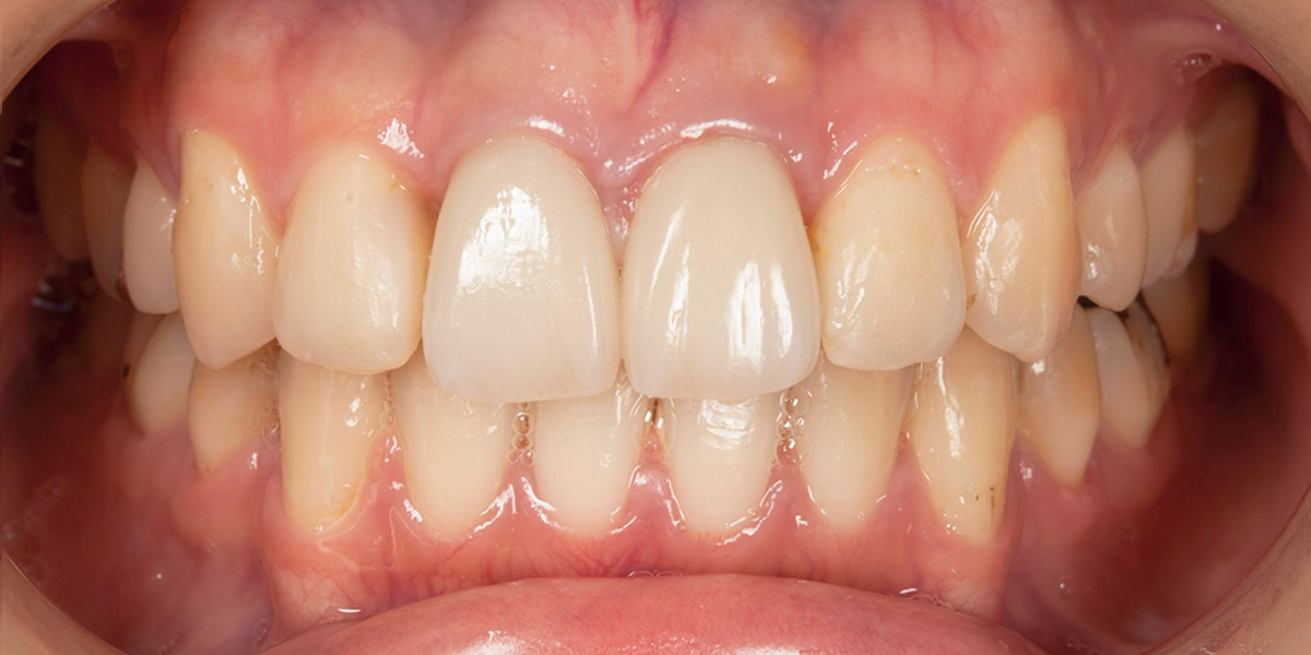 治療後写真 | 噛み合わせ治療・矯正歯科専門 荒谷デンタルクリニック