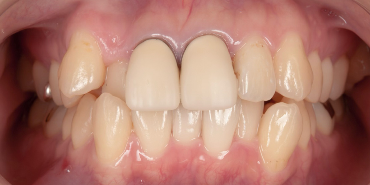 治療前写真 | 噛み合わせ治療・矯正歯科専門 荒谷デンタルクリニック