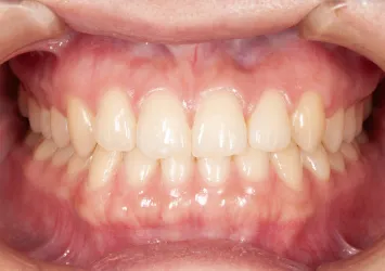 治療後写真 | 噛み合わせ治療・矯正歯科専門 荒谷デンタルクリニック