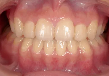 治療後写真 | 噛み合わせ治療・矯正歯科専門 荒谷デンタルクリニック