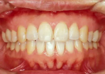 治療後写真 | 噛み合わせ治療・矯正歯科専門 荒谷デンタルクリニック