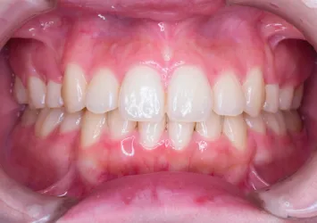 治療後写真 | 噛み合わせ治療・矯正歯科専門 荒谷デンタルクリニック