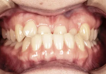 治療前写真 | 噛み合わせ治療・矯正歯科専門 荒谷デンタルクリニック