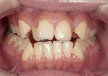 治療前写真 | 噛み合わせ治療・矯正歯科専門 荒谷デンタルクリニック