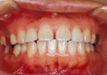 治療前写真 | 噛み合わせ治療・矯正歯科専門 荒谷デンタルクリニック