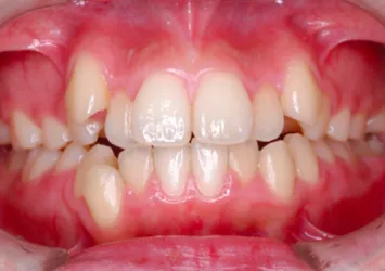 治療前写真 | 噛み合わせ治療・矯正歯科専門 荒谷デンタルクリニック