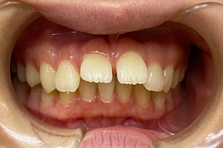 歯並びの例 | 噛み合わせ治療・矯正歯科専門 荒谷デンタルクリニック