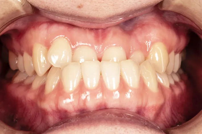 歯並びの例 | 噛み合わせ治療・矯正歯科専門 荒谷デンタルクリニック