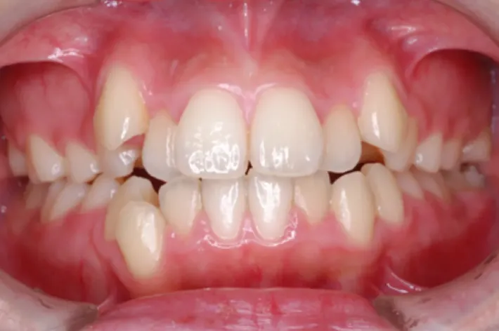 歯並びの例 | 噛み合わせ治療・矯正歯科専門 荒谷デンタルクリニック