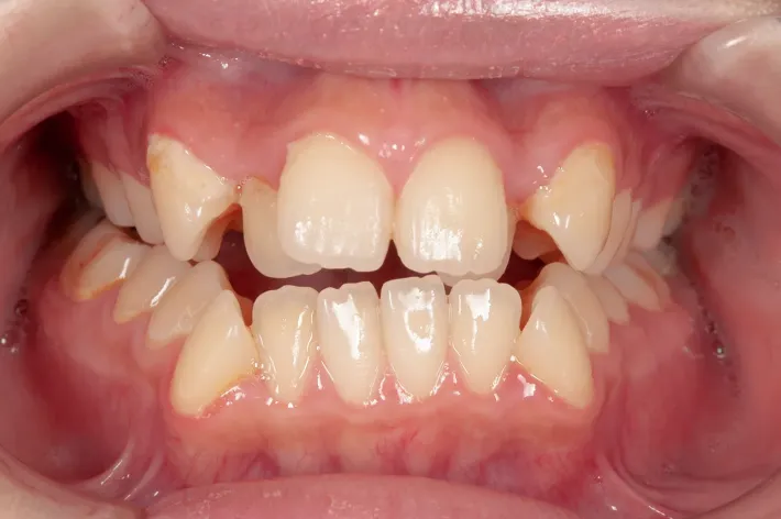 歯並びの例 | 噛み合わせ治療・矯正歯科専門 荒谷デンタルクリニック