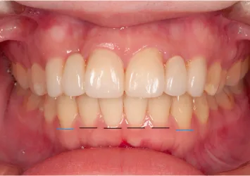 治療後写真 | 噛み合わせ治療・矯正歯科専門 荒谷デンタルクリニック