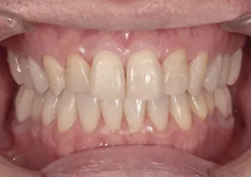 治療後写真 | 噛み合わせ治療・矯正歯科専門 荒谷デンタルクリニック