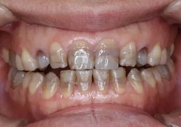 治療前写真 | 噛み合わせ治療・矯正歯科専門 荒谷デンタルクリニック