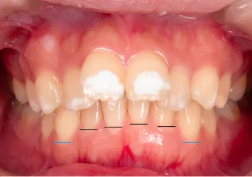 治療前写真 | 噛み合わせ治療・矯正歯科専門 荒谷デンタルクリニック