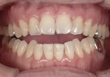 治療前写真 | 噛み合わせ治療・矯正歯科専門 荒谷デンタルクリニック