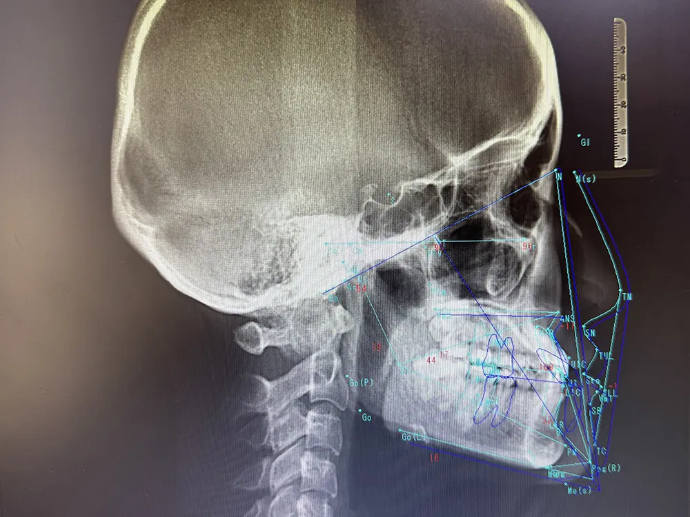 レントゲン写真