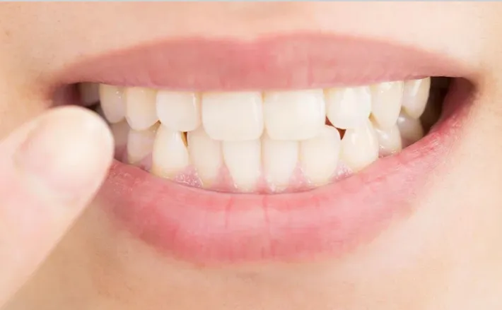 噛み合わせの写真 | 噛み合わせ治療・矯正歯科専門 荒谷デンタルクリニック